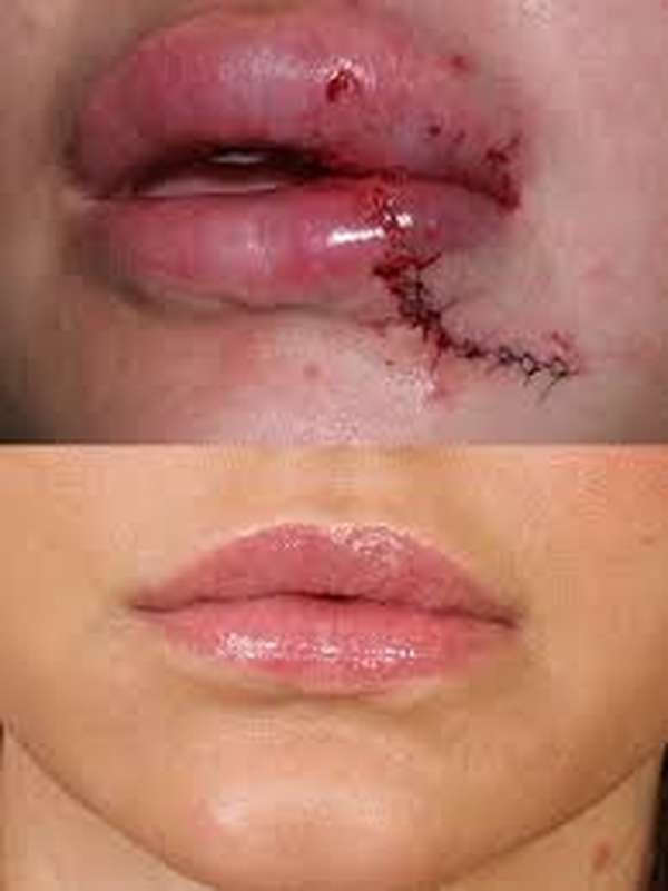 Chấn thương vùng miệng - Hình ảnh minh họa